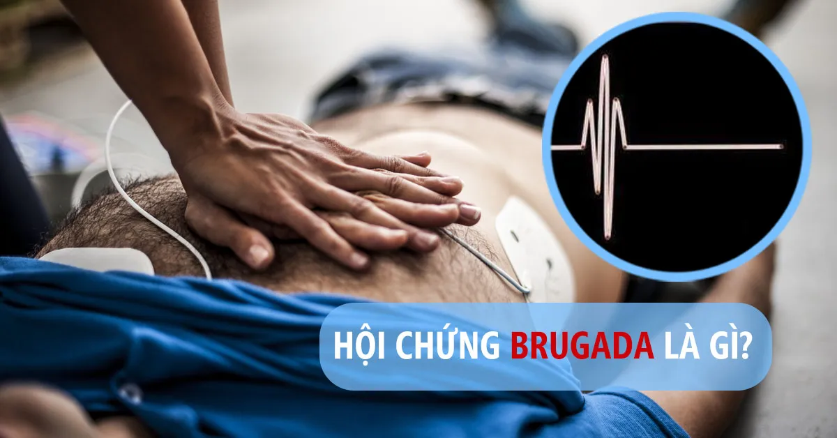 Hội chứng Brugada là gì? Cách chẩn đoán và điều trị bệnh hiệu quả