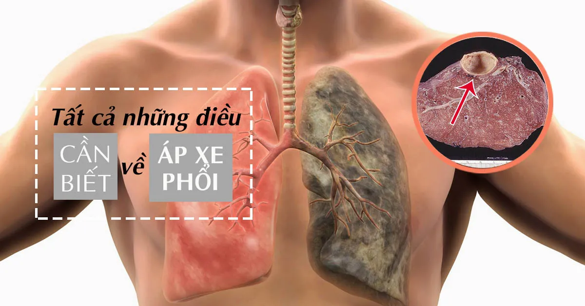 Áp xe phổi và những điều nên biết