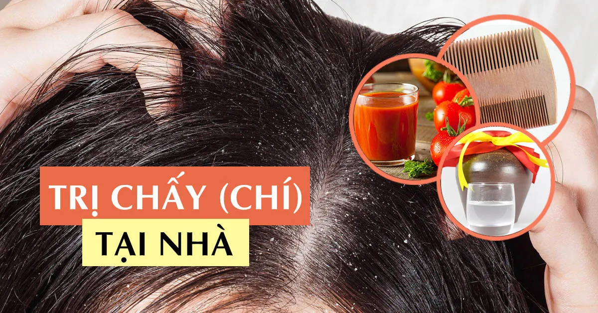 Tìm hiểu 6 cách trị chấy tại nhà hiệu quả