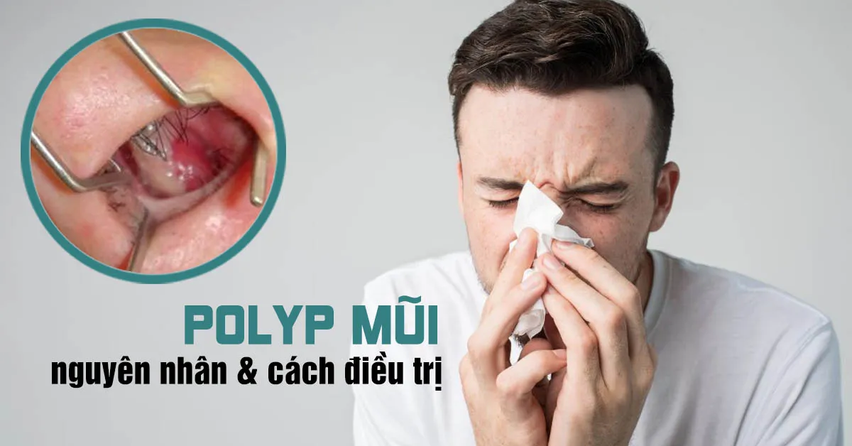 Tìm hiểu tổng quan về bệnh polyp mũi