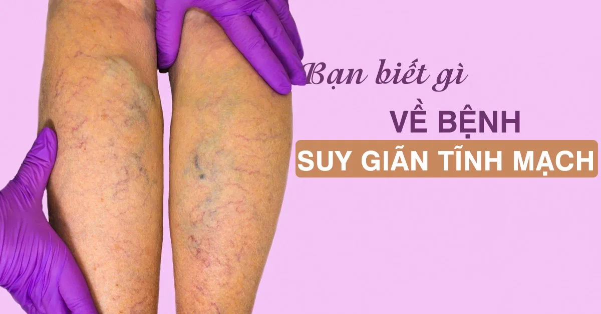 Tìm hiểu về bệnh suy giãn tĩnh mạch và cách điều trị