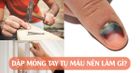 Dập móng tay – nguyên nhân và cách xử lý máu bầm