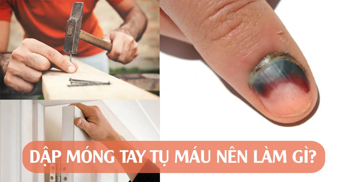 Dập móng tay – nguyên nhân và cách xử lý máu bầm