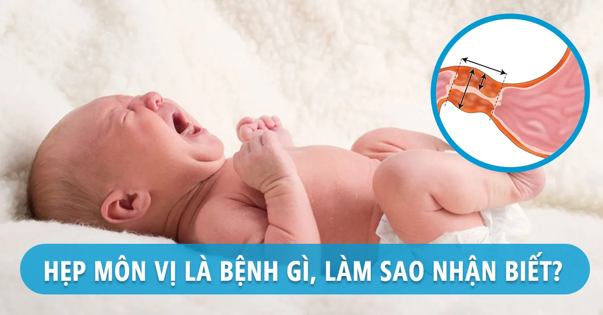Tìm hiểu bệnh hẹp môn vị ở trẻ em