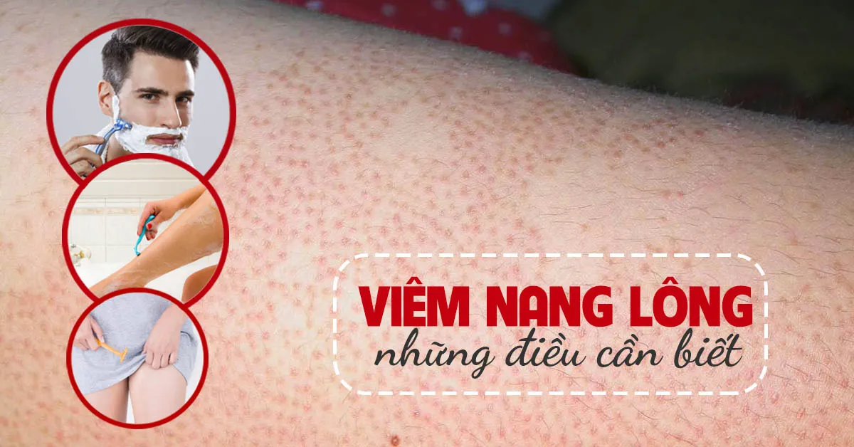 Viêm nang lông: Triệu chứng, nguyên nhân và thuốc điều trị