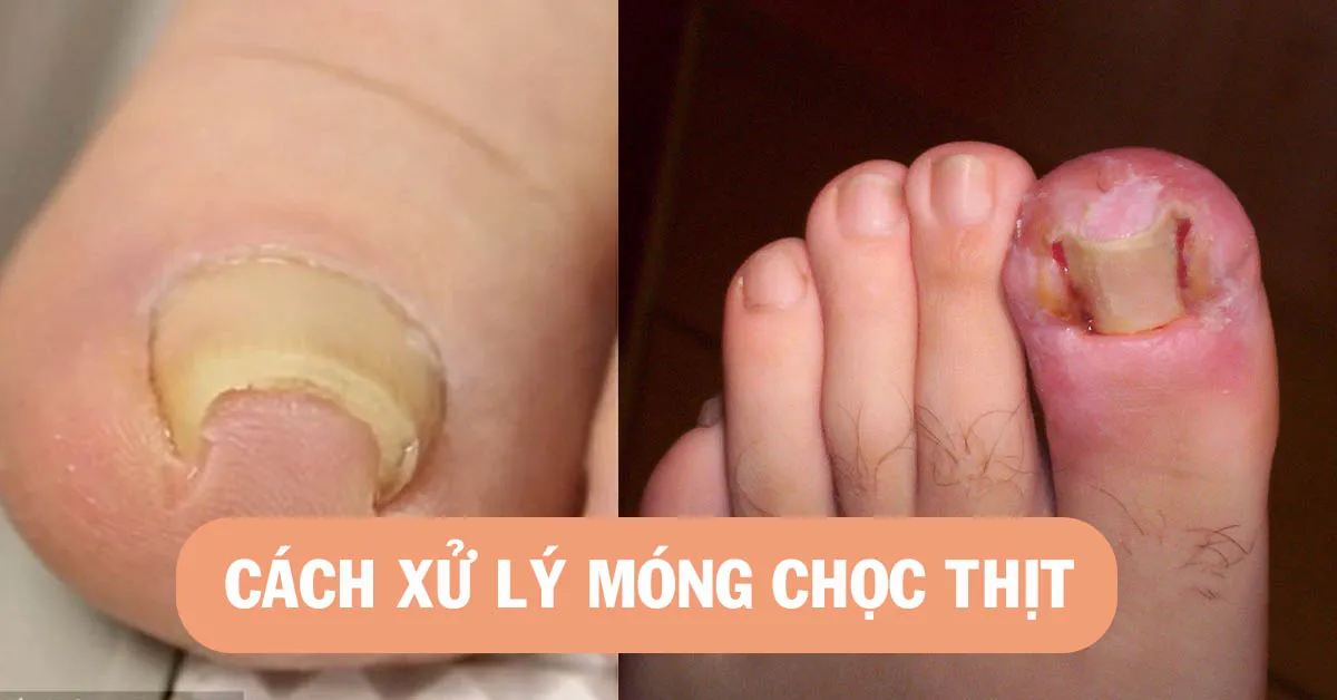 Móng chọc thịt - nguyên nhân và cách chữa