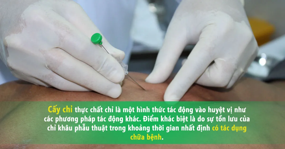 Tìm hiểu về phương pháp cấy chỉ trong việc phòng và trị bệnh