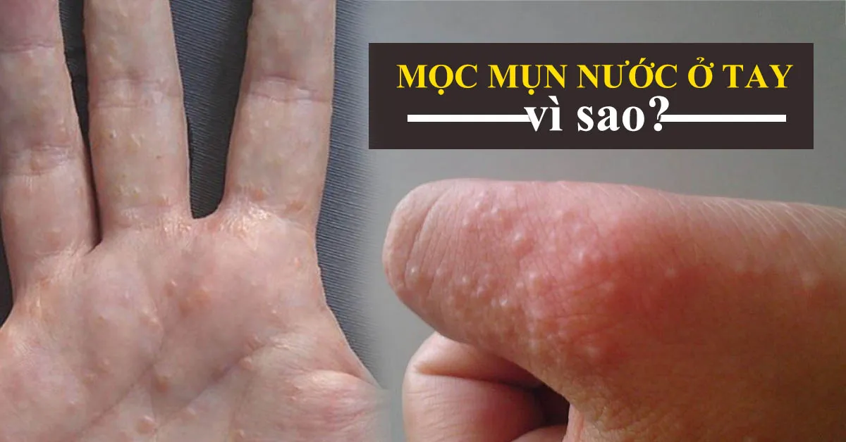 Những nguyên nhân gây mọc mụn nước ở tay