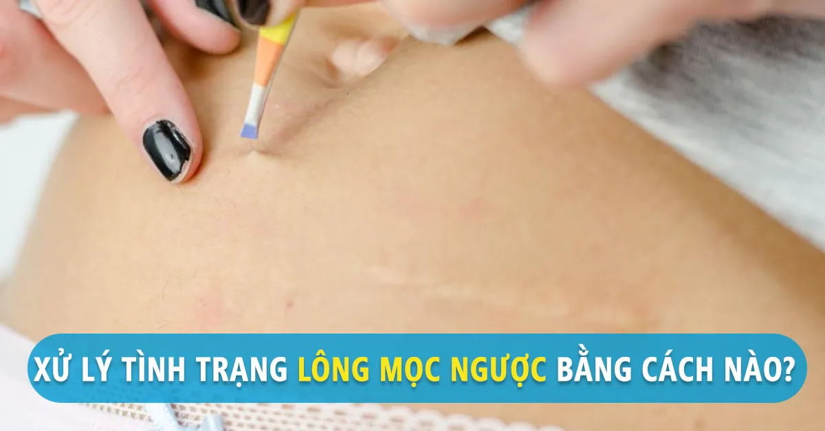 7 nguyên nhân khiến lông mọc ngược và cách xử lý