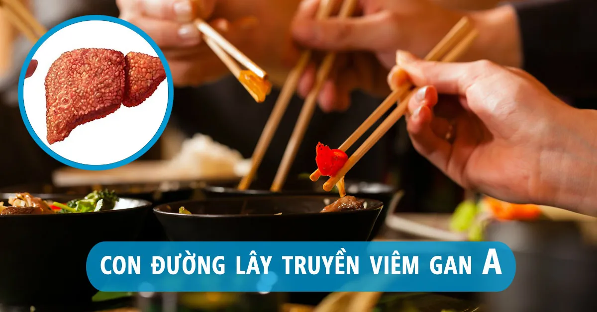 Viêm gan A: Con đường lây truyền, dấu hiệu nhận biết và phòng tránh