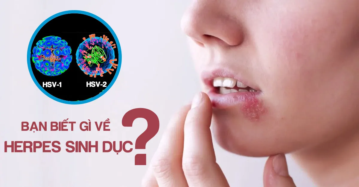 Herpes sinh dục là bệnh gì? Cách nhận biết và phòng ngừa