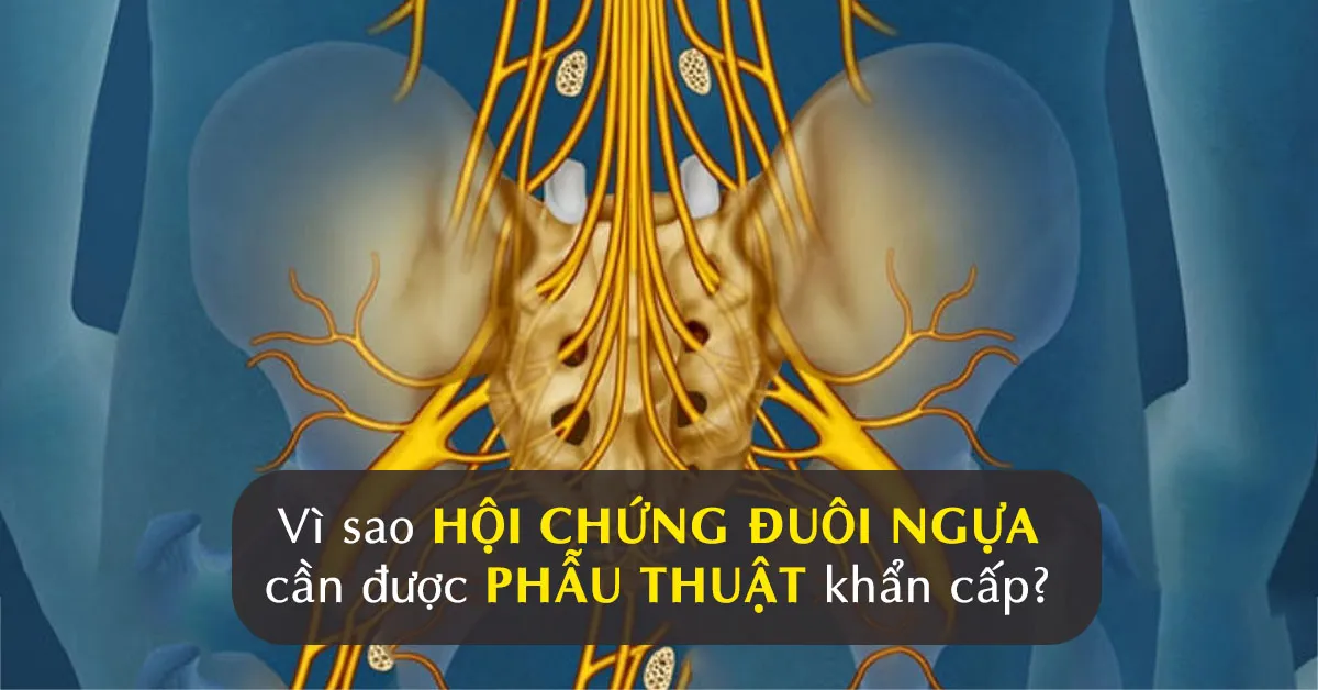 Hội chứng đuôi ngựa: Nguyên nhân và biện pháp phòng ngừa bệnh