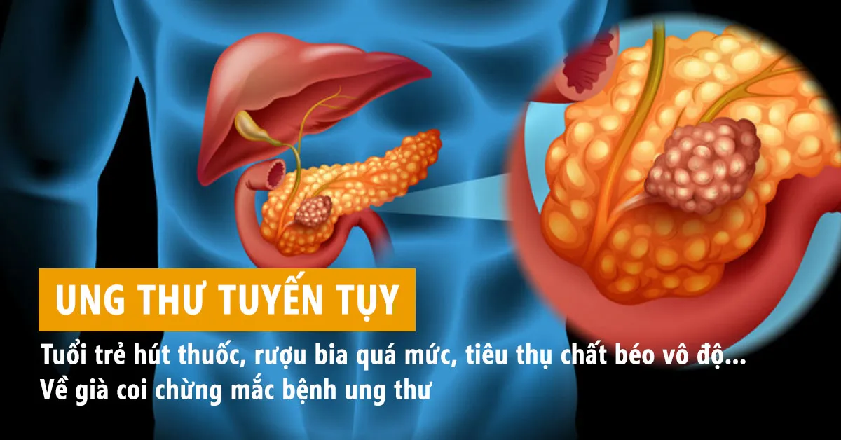 Ung thư tuyến tụy và những điều nên biết