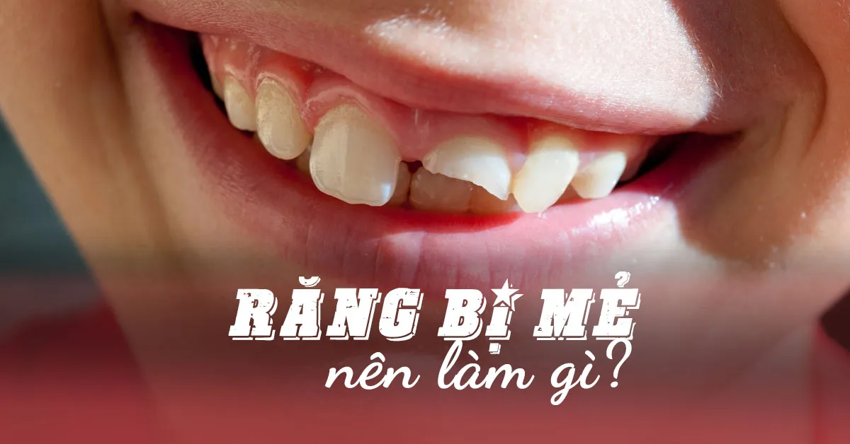 Răng bị mẻ phải làm sao?