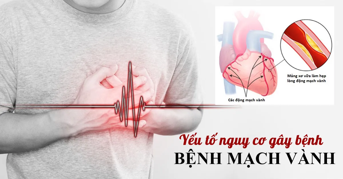 Tìm hiểu đầy đủ về bệnh mạch vành