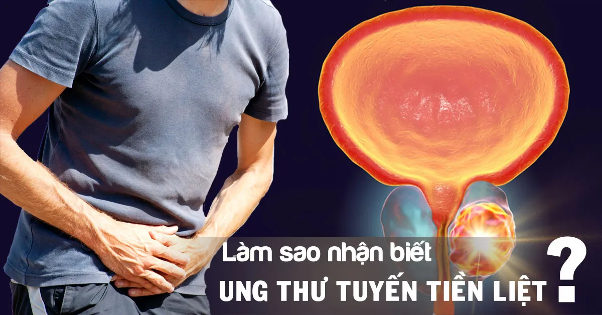 Ung thư tuyến tiền liệt là gì? Triệu chứng nhận biết và cách điều trị