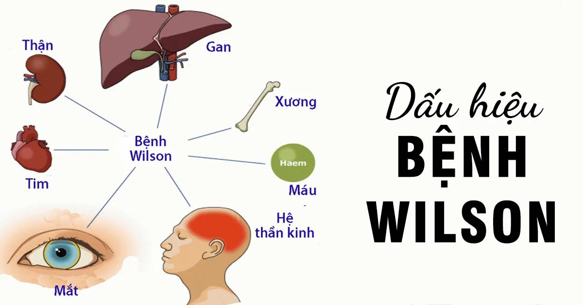 Bệnh wilson là gì và cách chẩn đoán bệnh chính xác?