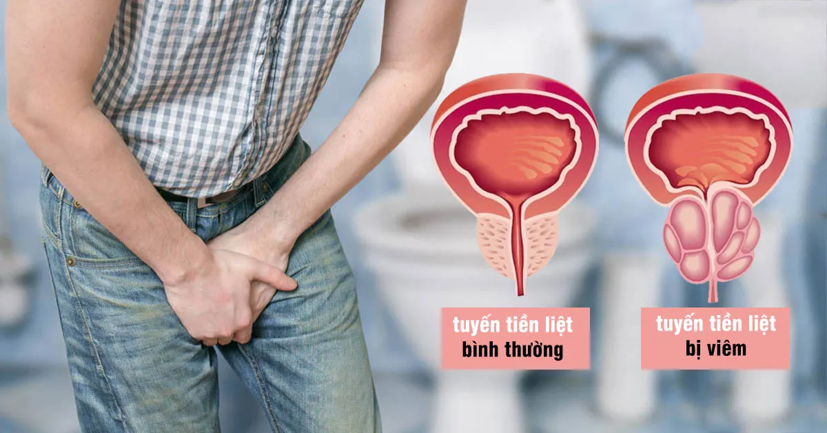 Viêm tuyến tiền liệt và những điều mà nam giới nên biết