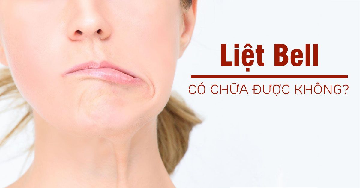 Liệt Bell là bệnh gì?