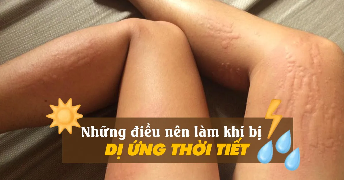 Dị ứng thời tiết: Dấu hiệu nhận biết và biện pháp phòng tránh