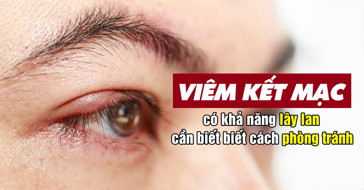 Những điều nên biết về bệnh viêm kết mạc và cách chữa trị an toàn