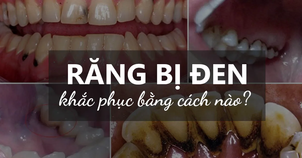 Những ‘thủ phạm’ khiến răng bị đen theo thời gian