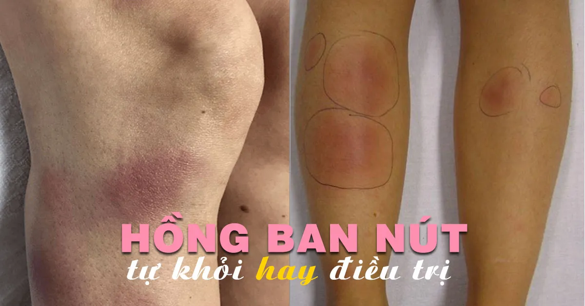 Hồng ban nút là bệnh gì, có lây không?