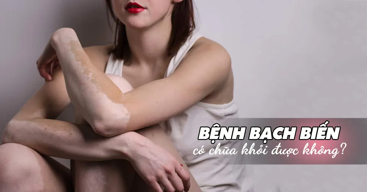 Bệnh bạch biến có chữa dứt điểm được không?