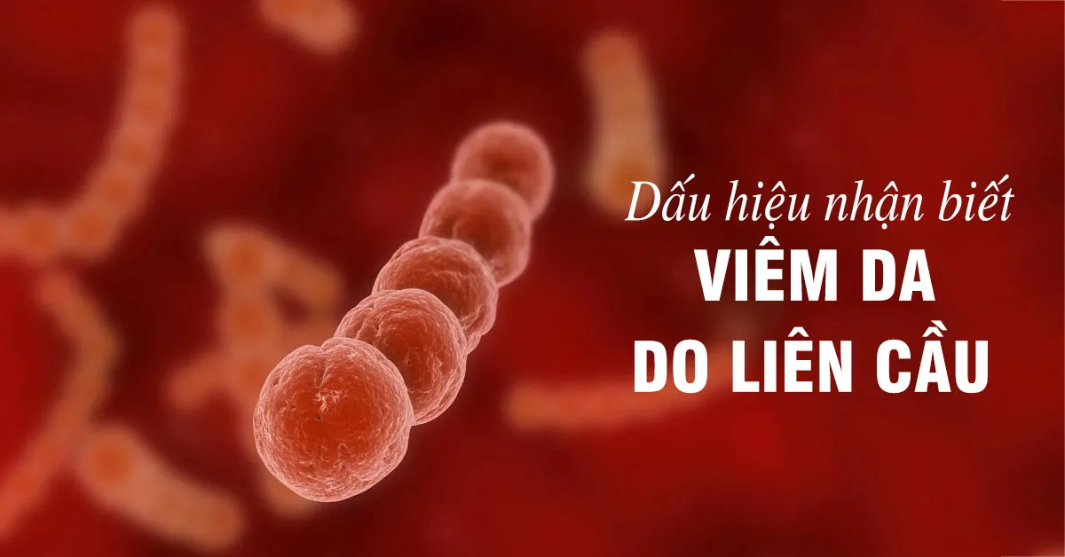 Viêm da liên cầu là gì? Nhận biết và chữa trị thế nào?