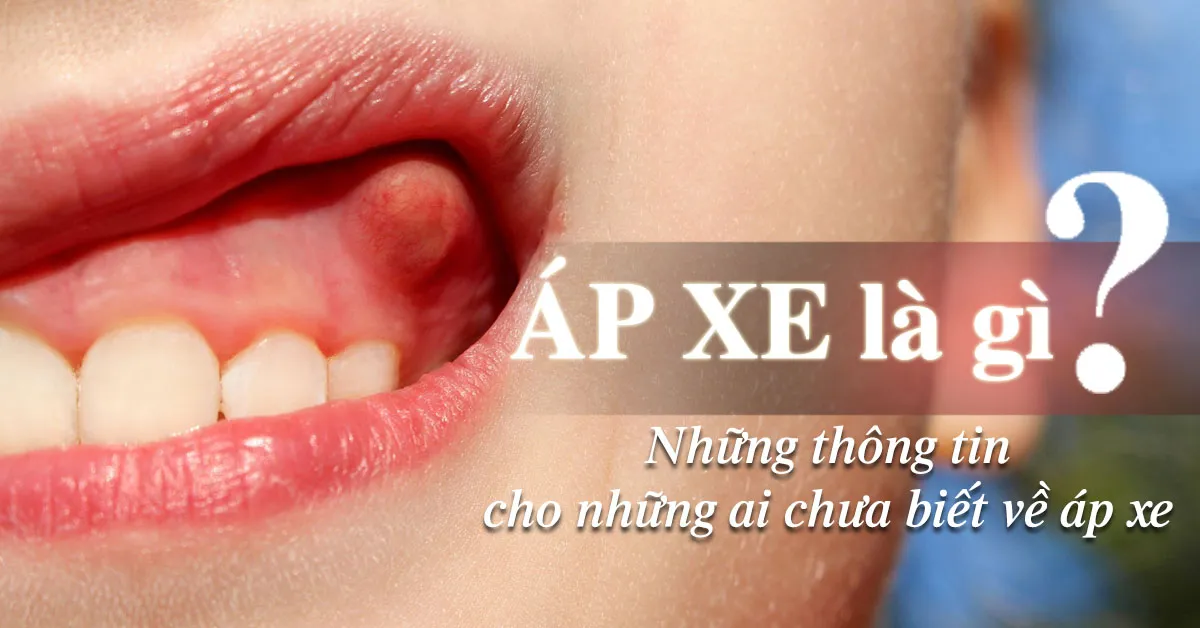 Áp xe là gì, có nguy hiểm không?