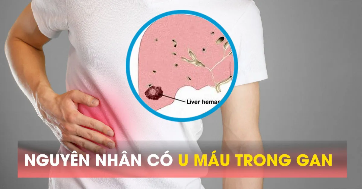 U máu gan có nguy hiểm không?