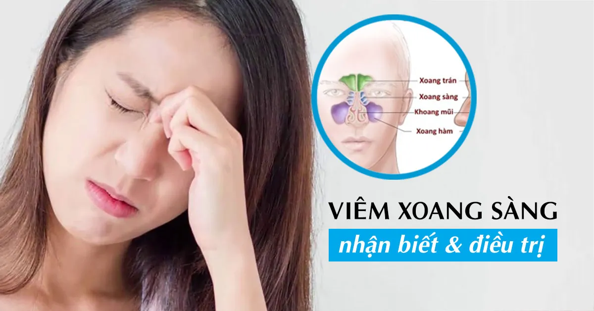 Viêm xoang sàng và những kiến thức nên biết