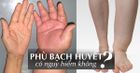 Phù bạch huyết là gì, có chữa được không?