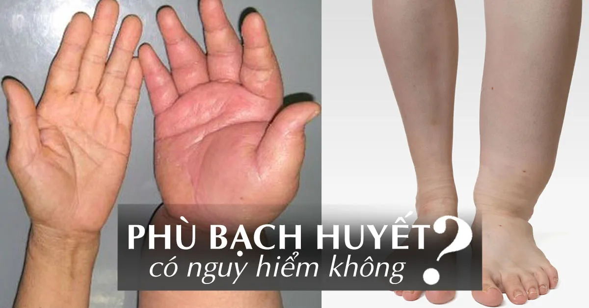 Phù bạch huyết là gì, có chữa được không?