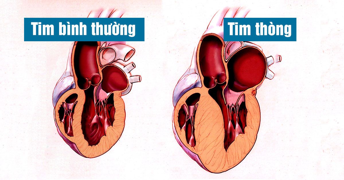 Tim thòng là gì, có nguy hiểm không?