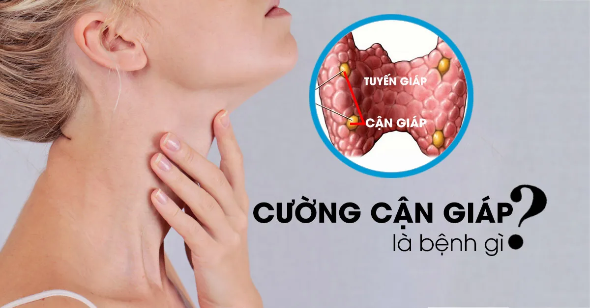Cường cận giáp là bệnh gì?