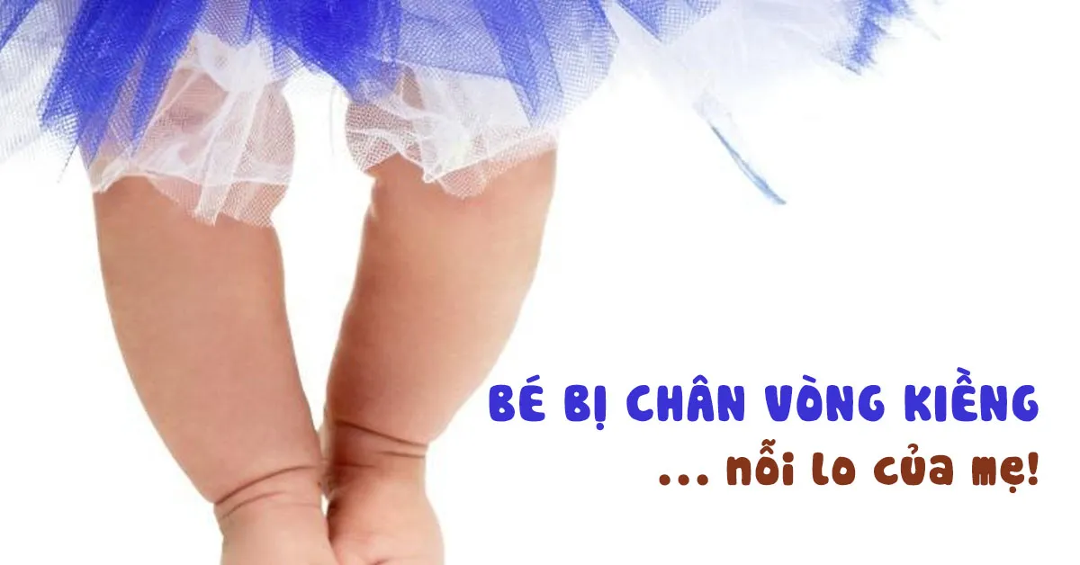 Nguyên nhân khiến bé bị chân vòng kiềng và cách khắc phục