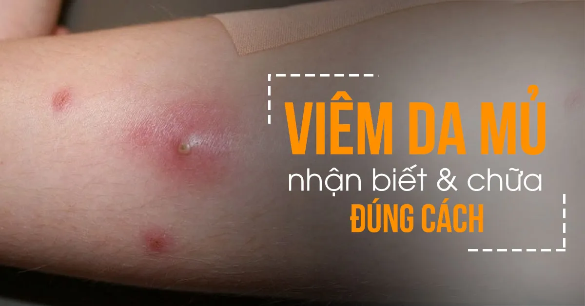 Nhận diện các dạng bệnh của viêm da mủ để chữa đúng cách