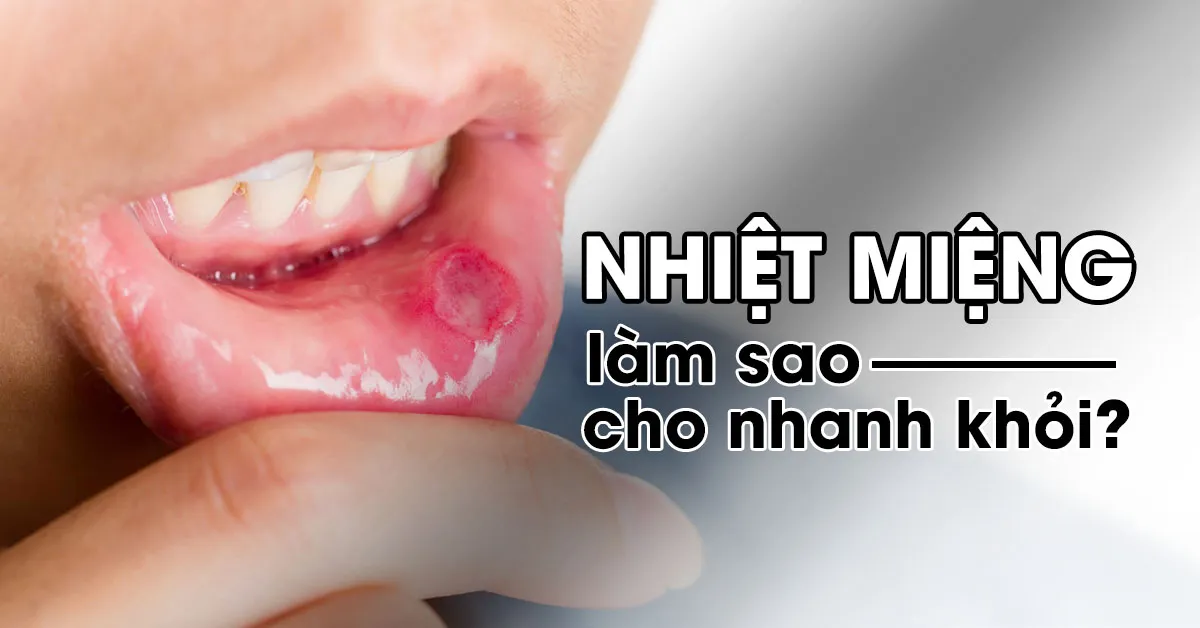 Nhiệt miệng – giải pháp ‘đẩy lùi’ bệnh cực nhanh