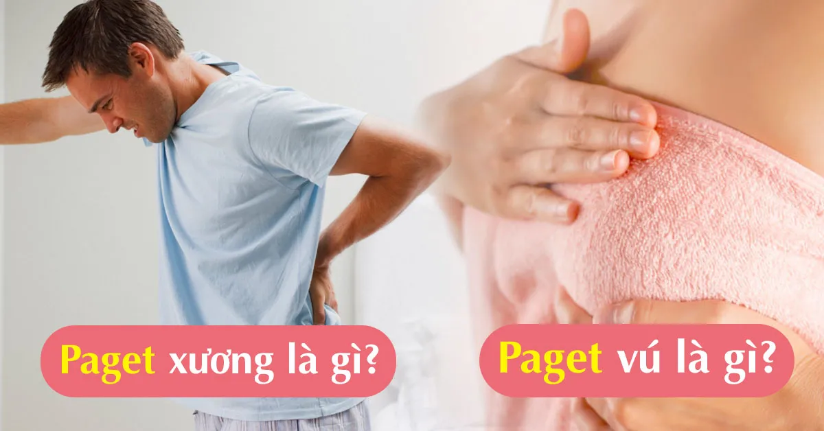 Tìm hiểu bệnh Paget là gì?