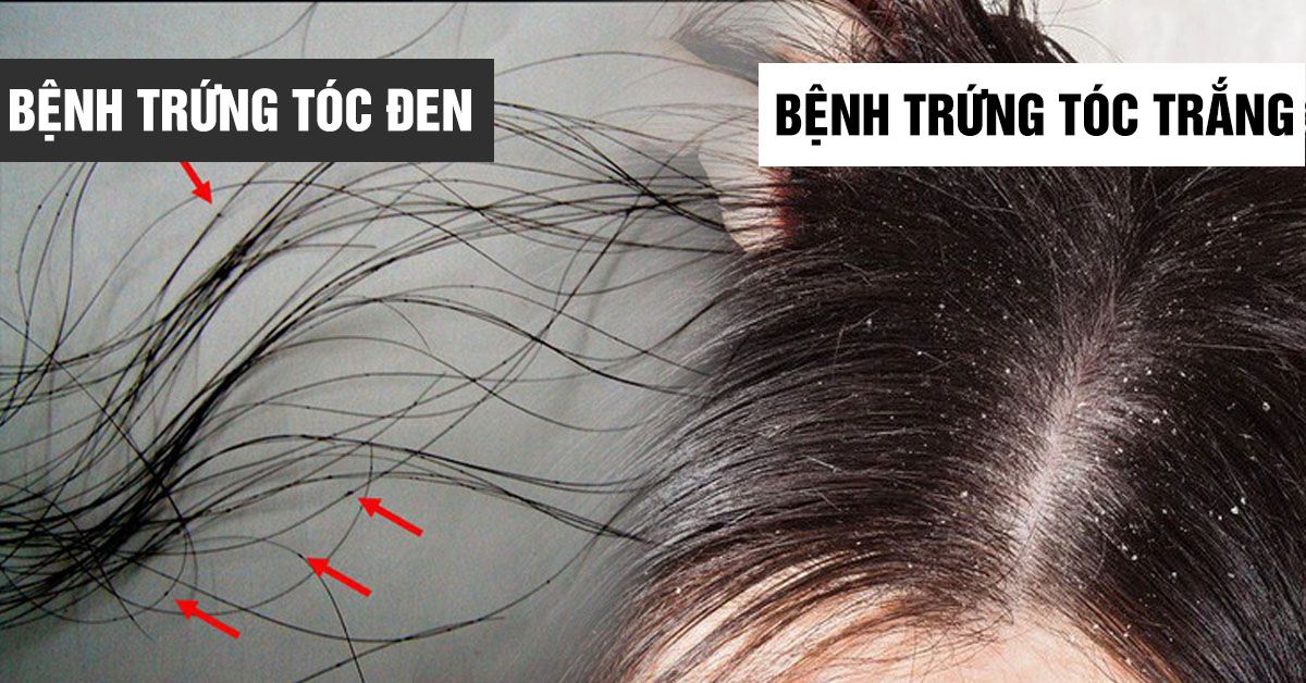 Trứng tóc: Nhận biết và điều trị