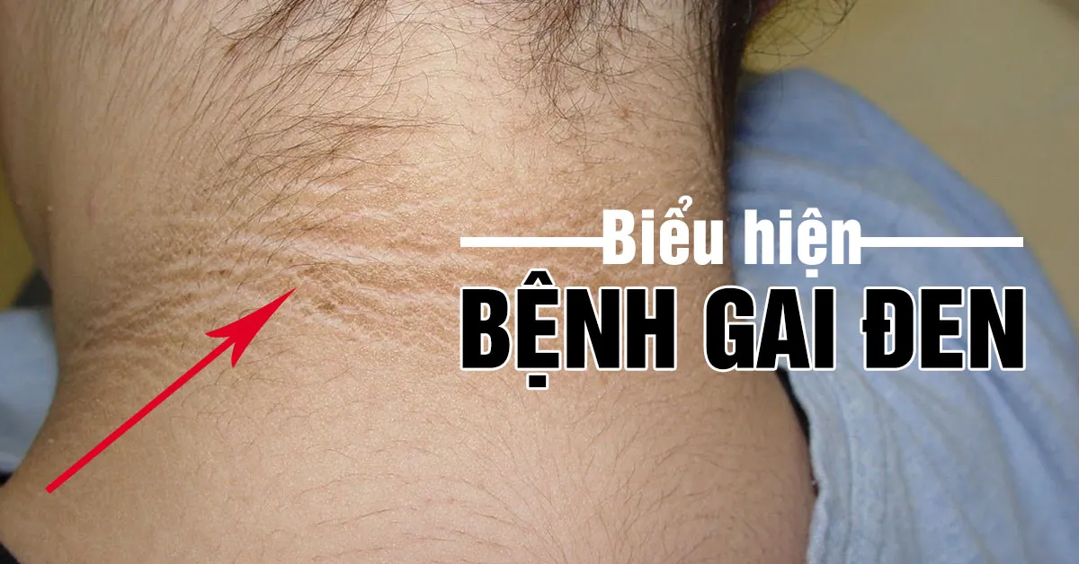 Bệnh gai đen – có thể là dấu hiệu cảnh báo bệnh ung thư trong cơ thể