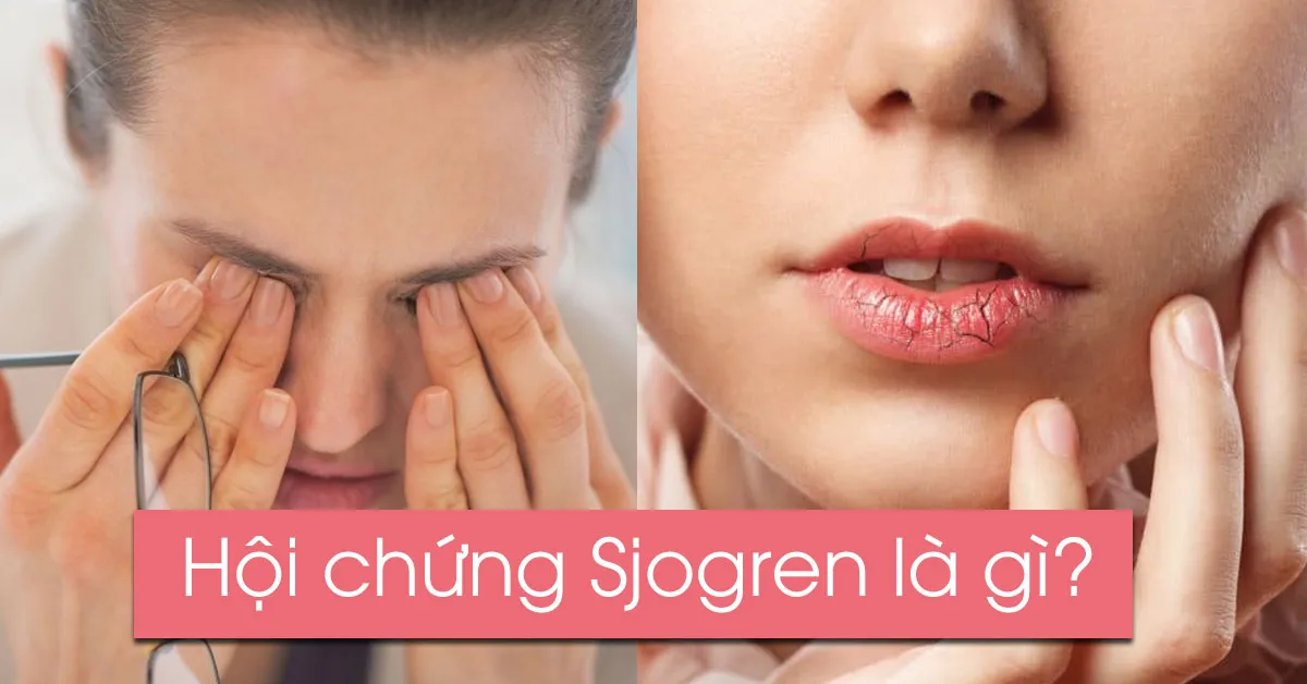 Hội chứng sjogren là gì?