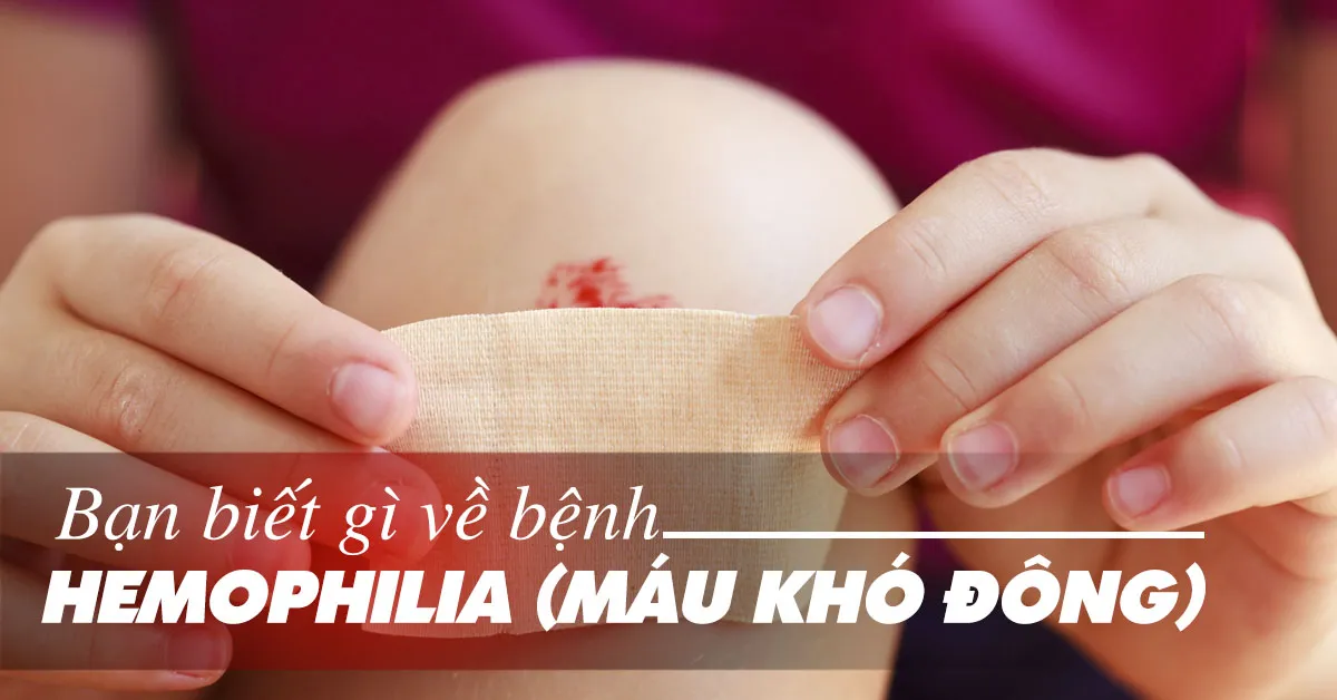 Hemophilia (bệnh máu khó đông) có chữa được không?