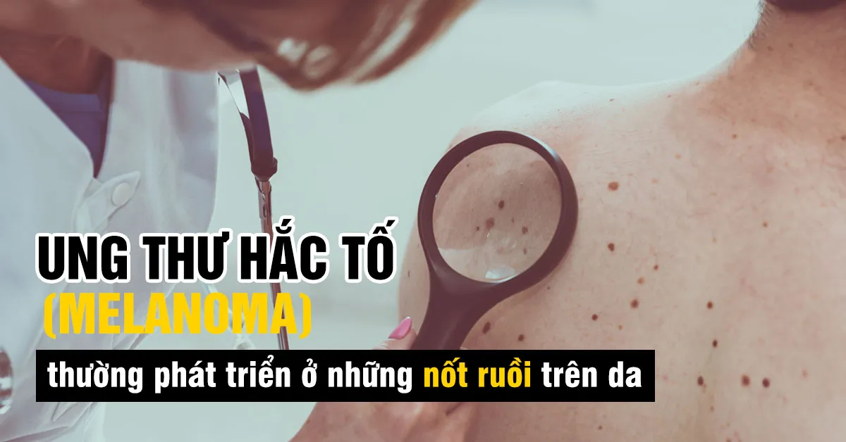 Melanoma là gì, bệnh này có chữa được không?