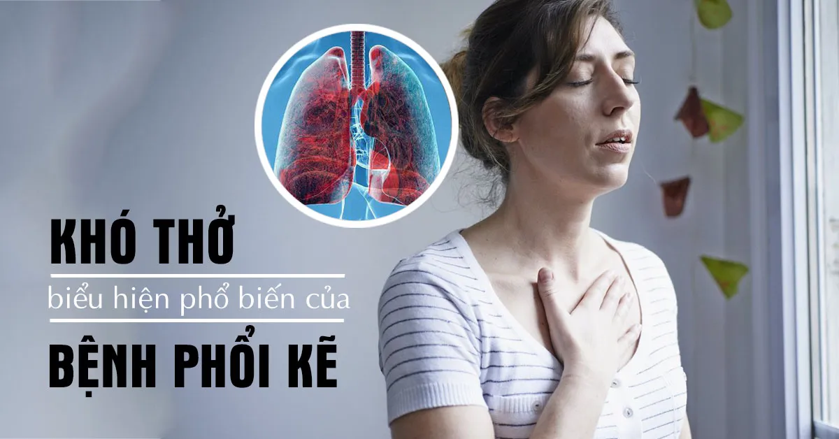 Những kiến thức cần biết về bệnh phổi kẽ