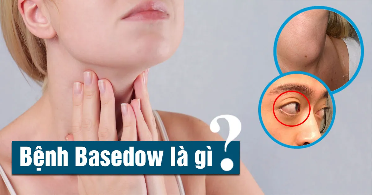 Bệnh basedow là gì, nhận biết và điều trị bằng cách nào?