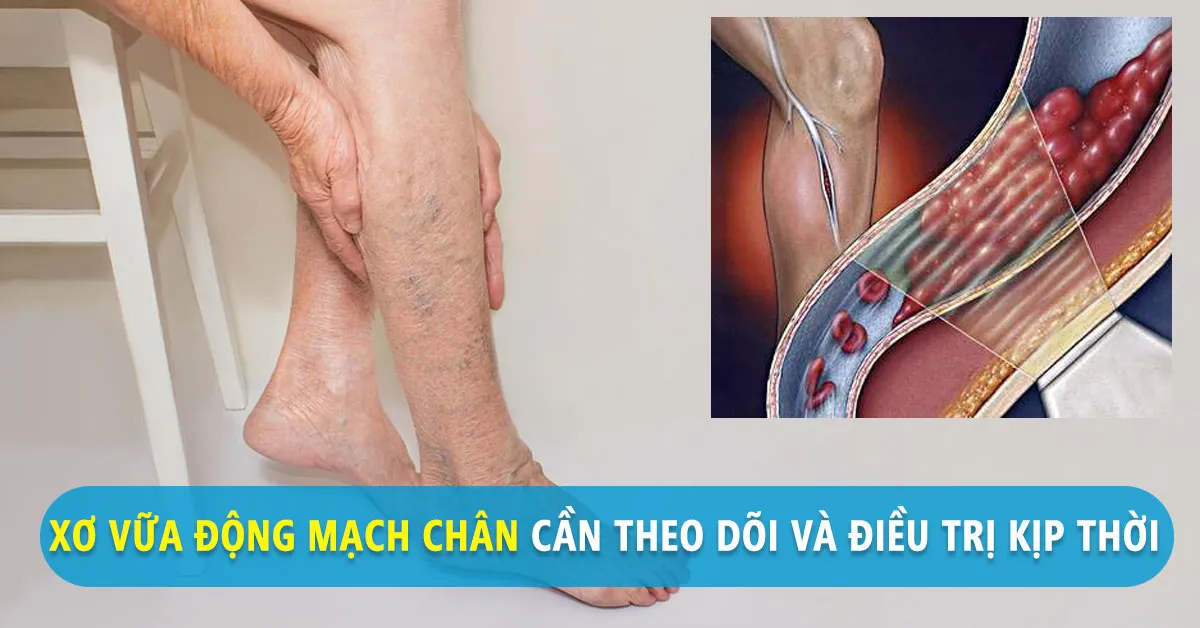 Xơ vữa động mạch chân gây đau mỗi khi bước đi phải làm sao cho nhanh khỏi?