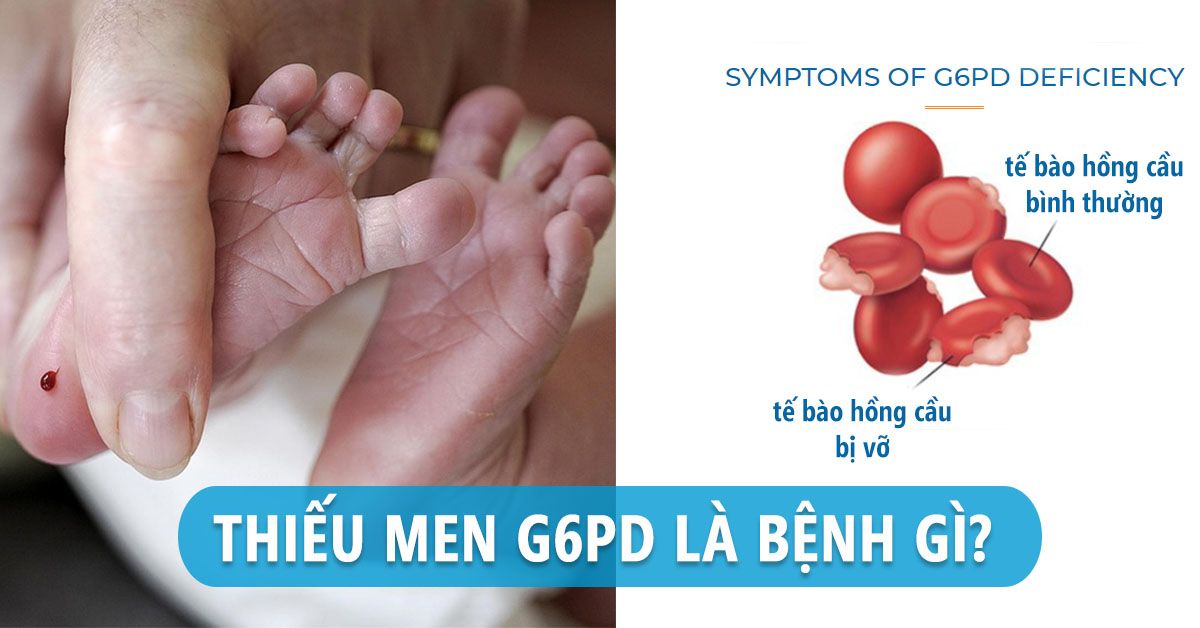 Thiếu men G6PD ở trẻ là bệnh gì? Có nguy hiểm không?