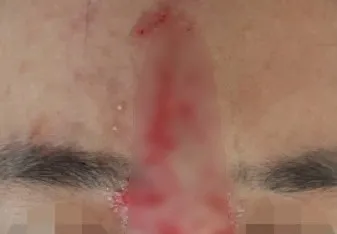 Tiêm filler, nhiều trường hợp bị biến chứng mất thị lực